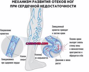 Варикоз 2 Степени Симптомы Боли