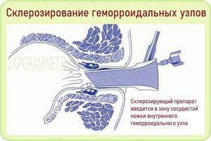 Детрагель После Склеротерапии