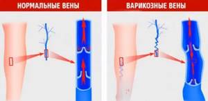 Варикоз Языка