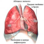 Абсцесс легкого