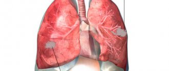 Абсцесс легкого