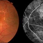 агниопатия сетчатки глаза