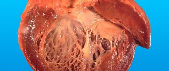 Alcoholic cardiomyopathy