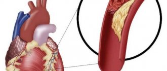 Анализы при ИБС что это