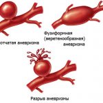 Аневризмы почечных артерий