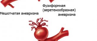 Аневризмы почечных артерий