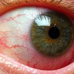 Ангиопатия сосудов сетчатки глаза: лечение, симптомы, причины