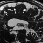 Brain arachnoiditis on MRI