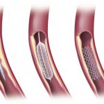Аритмия после шунтирования сердца - Лечение гипертонии