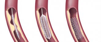 Аритмия после шунтирования сердца - Лечение гипертонии