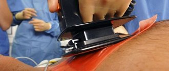 Arrhythmogenic right ventricular dysplasia