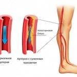 Атероматозная бляшка сужает просвет артерии в ноге