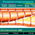 Атеросклероз сосудов сердца. Симптомы и лечение у пожилых людей, причины