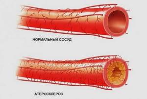 Атеросклероз сосудов у мужчин