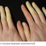 Атеросклероз сосудов верхних конечностей