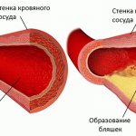 Атеротромбоз – основная причина назначения Аспирина фото