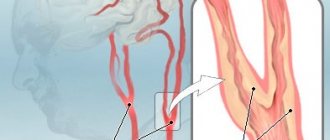 Бляшки в сонных артериях являются самой частой причиной ишемического инсульта