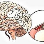 Plaques in the blood vessels of the brain