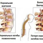 болезнь бехтерева симптомы