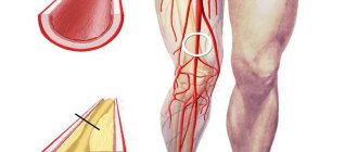 Vascular disease of the legs