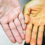 Больной желтухой