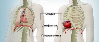 Что такое эктопия сердца