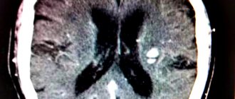 что такое глиозные очаги