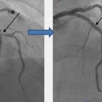 Что такое стентирование сосудов нижних конечностей