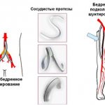 Диагностика атеросклероза нижних конечностей