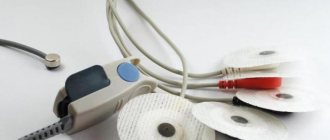 экг показывает инфаркт