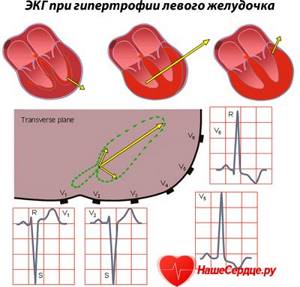 ЭКГ при гипертрофии левого желудочка сердца