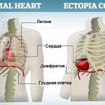 Эктопия сердца