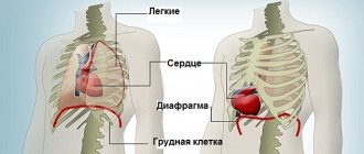 Эктопия сердца