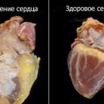 Если человек ведет здоровый образ жизни, наследственный фактор не сможет спровоцировать развитие дистрофии миокарда.