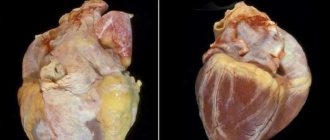 If a person leads a healthy lifestyle, a hereditary factor will not be able to provoke the development of myocardial dystrophy.