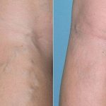 Этиология и терапия тромбоза подколенной вены