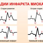 Фазы инфаркта миокарда