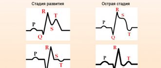 Фазы инфаркта миокарда