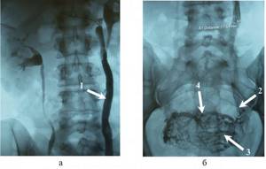 Варикозные вены малого таза. Флебография вен малого таза. Флебография варикоз малого таза.