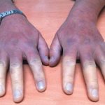 Фото акроцианоз