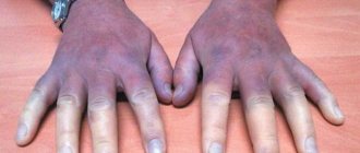 Фото акроцианоз
