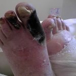 Гангрена нижних конечностей: виды, лечение, прогноз