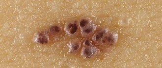 hemangioma photo description