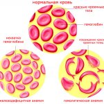 гемолитическая анемия