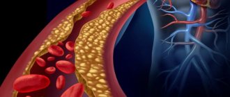 генерализованный атеросклероз мкб 10