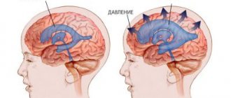 Гидроцефалия головного мозга