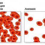 Гиперхромная анемия