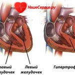 Гипертрофия левого желудочка сердца