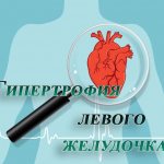 Гипертрофия левого желудочка сердца – причины, лечение, симптомы на ЭКГ. Чем опасна гипертрофия левого желудочка сердца?