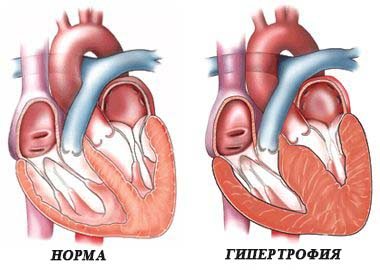 Гипертрофия левого желудочка сердца – причины, лечение, симптомы на ЭКГ. Чем опасна гипертрофия левого желудочка сердца?
